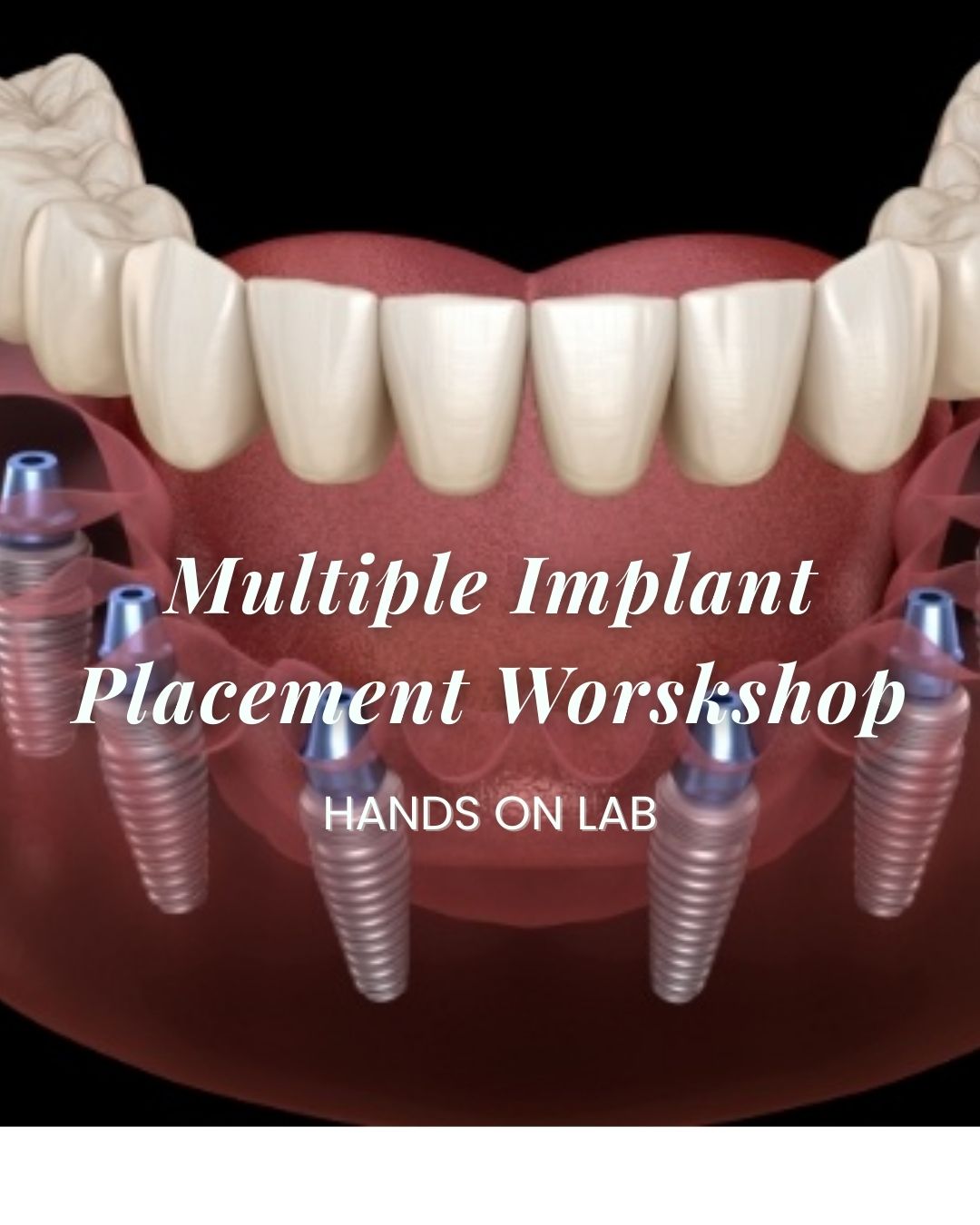 Dental Implant Course Philippines