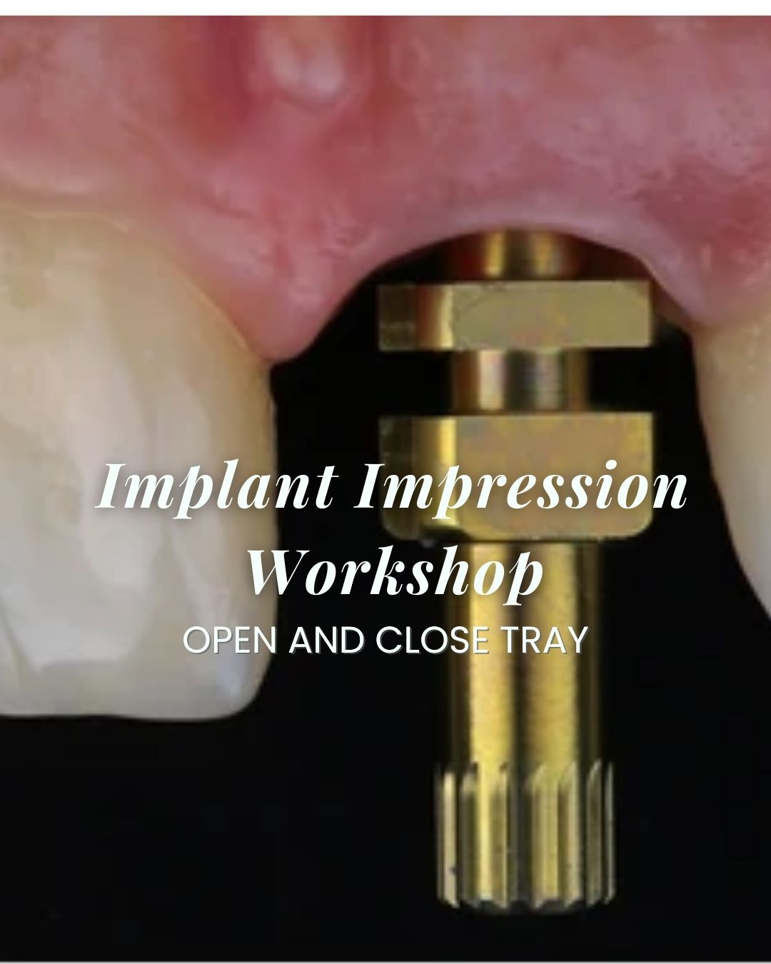 Dental Implant Education PADICE